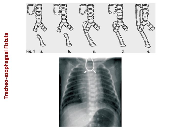 Tracheo-esophageal Fistula 