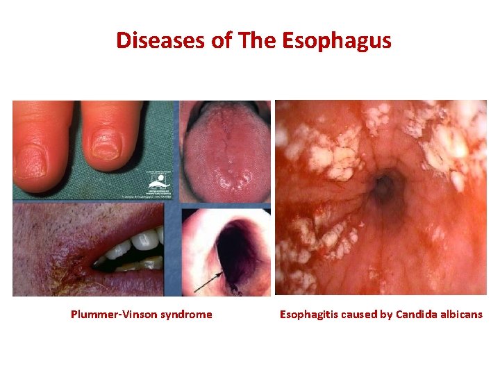 Diseases of The Esophagus Plummer-Vinson syndrome Esophagitis caused by Candida albicans 