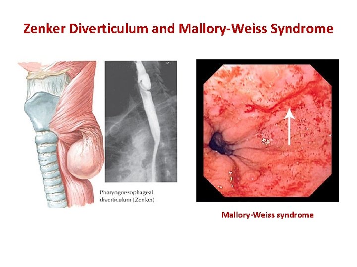 Zenker Diverticulum and Mallory-Weiss Syndrome Mallory-Weiss syndrome 
