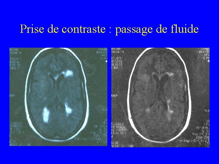 Prise de contraste : passage de fluide 