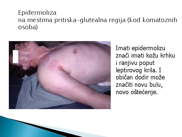 Epidermoliza na mestima pritiska-glutealna regija (kod komatoznih osoba) Imati epidermolizu znači imati kožu krhku