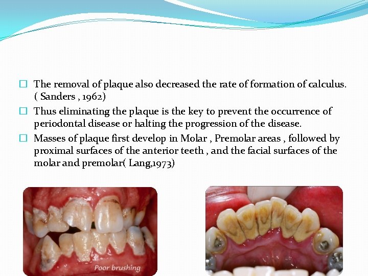 � The removal of plaque also decreased the rate of formation of calculus. (