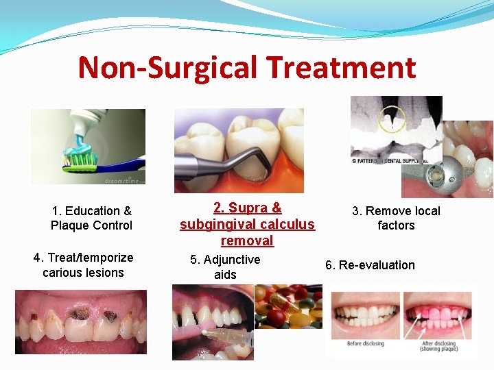 Non-Surgical Treatment 1. Education & Plaque Control 4. Treat/temporize carious lesions 2. Supra &