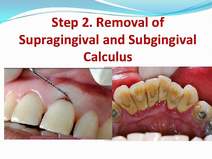 Step 2. Removal of Supragingival and Subgingival Calculus 