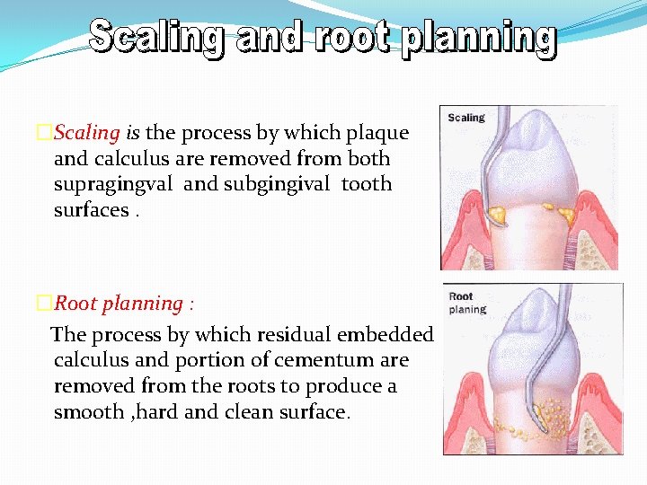 �Scaling is the process by which plaque and calculus are removed from both supragingval