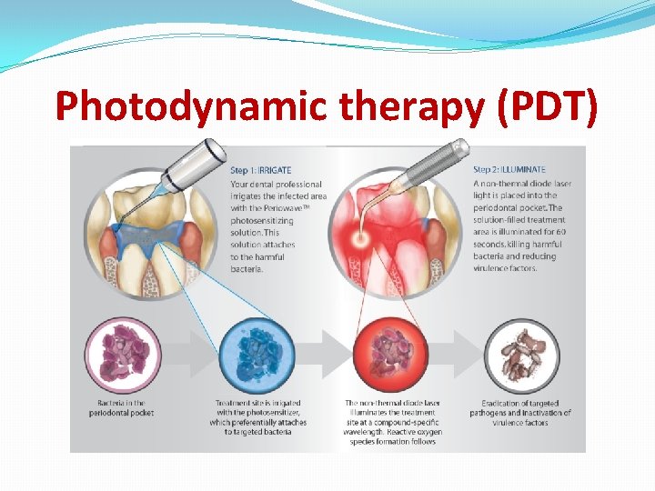 Photodynamic therapy (PDT) 