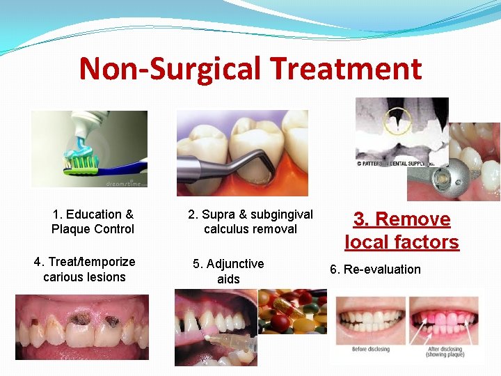 Non-Surgical Treatment 1. Education & Plaque Control 4. Treat/temporize carious lesions 2. Supra &