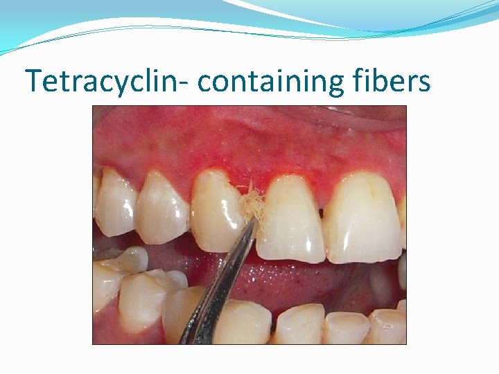 Tetracyclin- containing fibers 