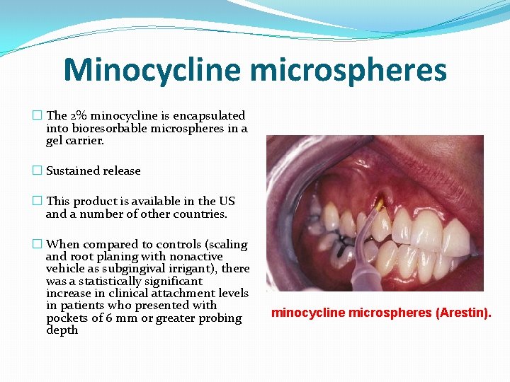 Minocycline microspheres � The 2% minocycline is encapsulated into bioresorbable microspheres in a gel