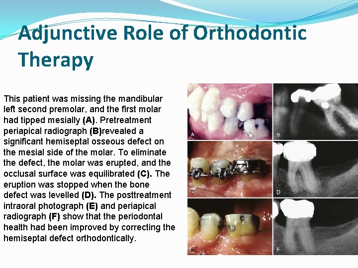 Adjunctive Role of Orthodontic Therapy This patient was missing the mandibular left second premolar,