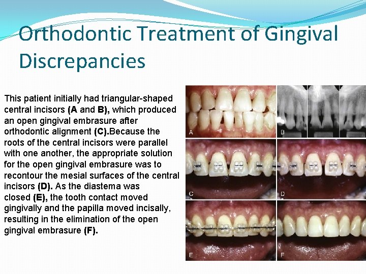 Orthodontic Treatment of Gingival Discrepancies This patient initially had triangular-shaped central incisors (A and