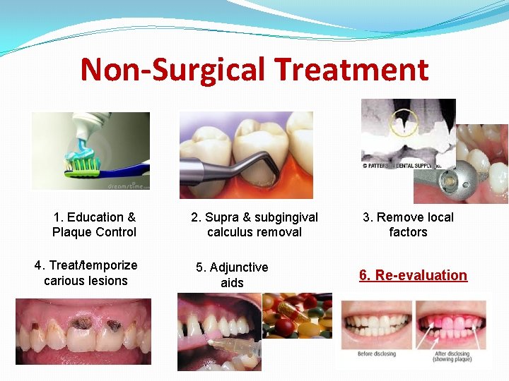 Non-Surgical Treatment 1. Education & Plaque Control 4. Treat/temporize carious lesions 2. Supra &