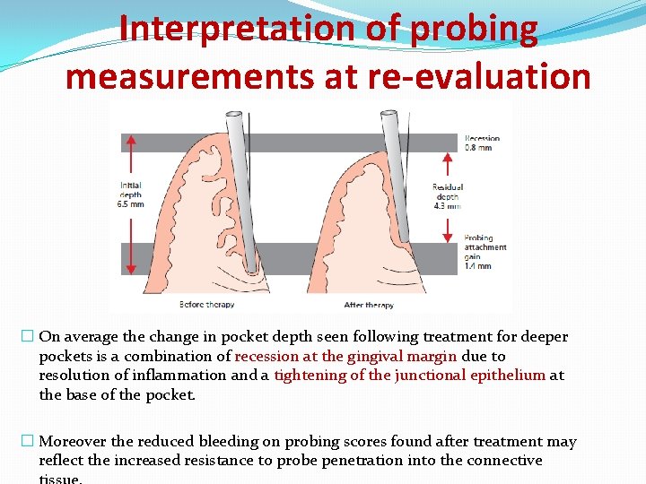 Interpretation of probing measurements at re-evaluation � On average the change in pocket depth