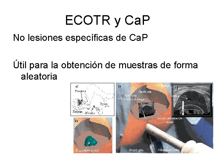 ECOTR y Ca. P No lesiones específicas de Ca. P Útil para la obtención