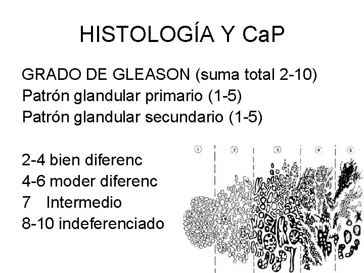 HISTOLOGÍA Y Ca. P GRADO DE GLEASON (suma total 2 -10) Patrón glandular primario