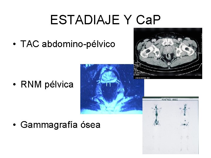 ESTADIAJE Y Ca. P • TAC abdomino-pélvico • RNM pélvica • Gammagrafía ósea 