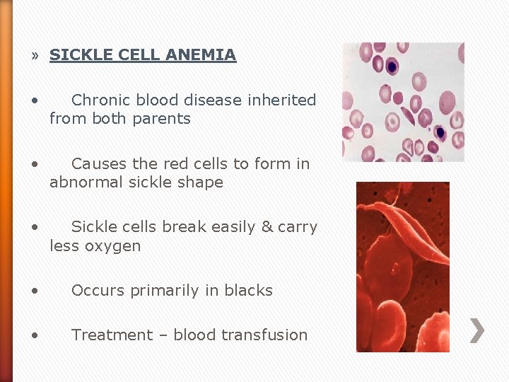 » SICKLE CELL ANEMIA • Chronic blood disease inherited from both parents • Causes