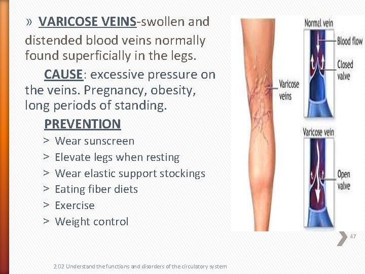 » VARICOSE VEINS-swollen and distended blood veins normally found superficially in the legs. CAUSE: