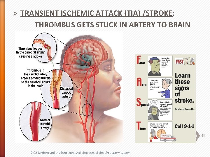 » TRANSIENT ISCHEMIC ATTACK (TIA) /STROKE: THROMBUS GETS STUCK IN ARTERY TO BRAIN 48