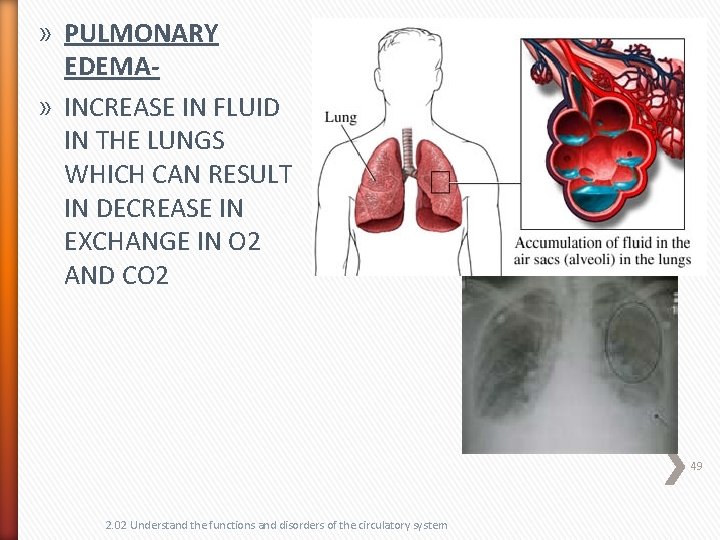 » PULMONARY EDEMA» INCREASE IN FLUID IN THE LUNGS WHICH CAN RESULT IN DECREASE