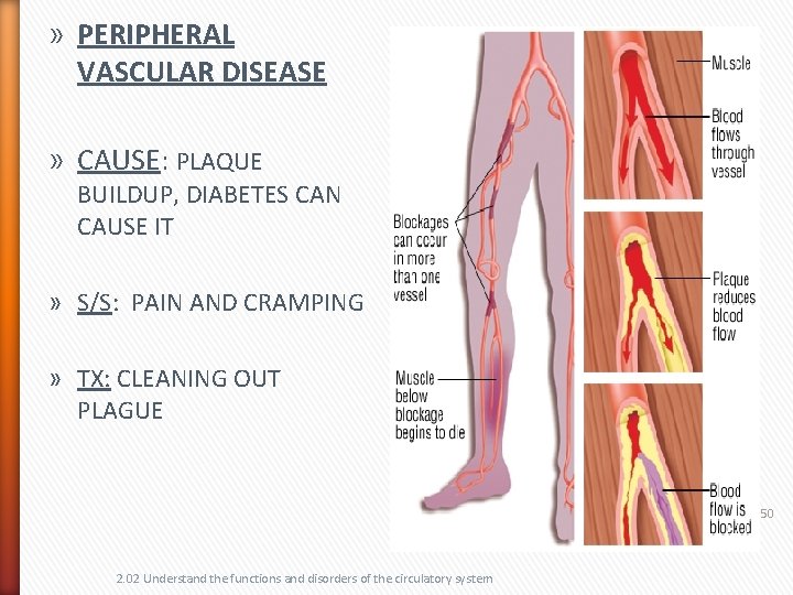 » PERIPHERAL VASCULAR DISEASE » CAUSE: PLAQUE BUILDUP, DIABETES CAN CAUSE IT » S/S: