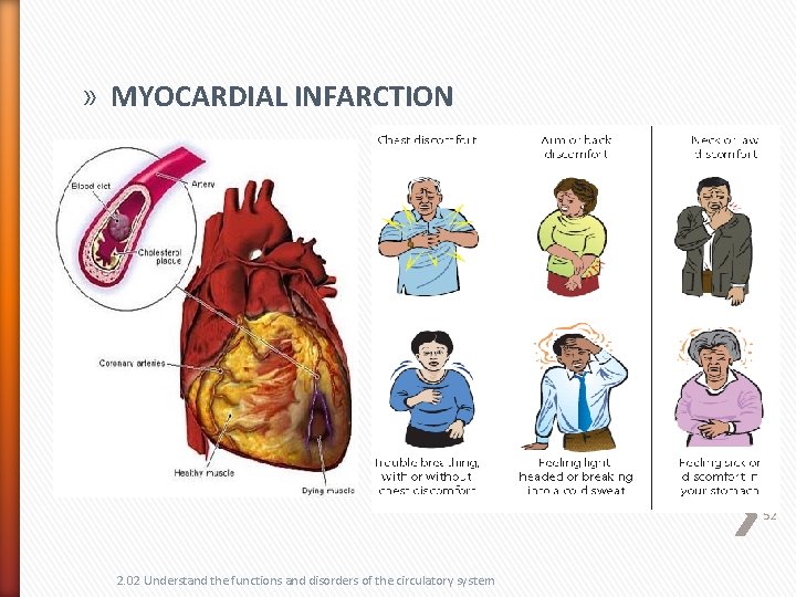 » MYOCARDIAL INFARCTION 52 2. 02 Understand the functions and disorders of the circulatory