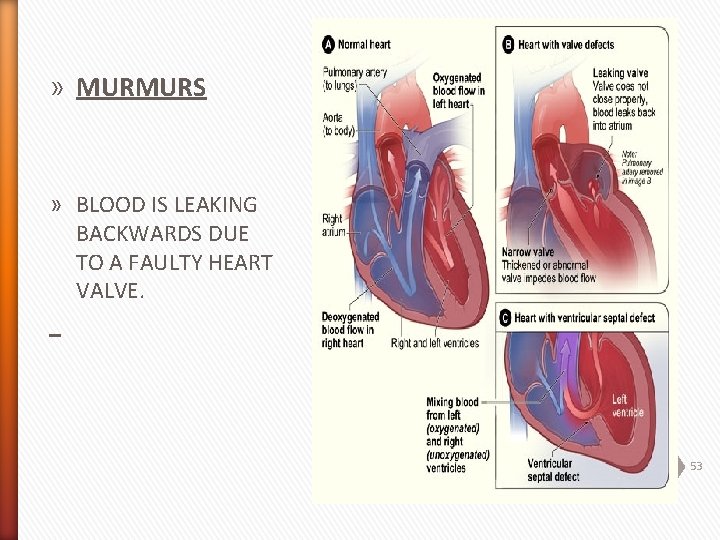 » MURMURS » BLOOD IS LEAKING BACKWARDS DUE TO A FAULTY HEART VALVE. 53