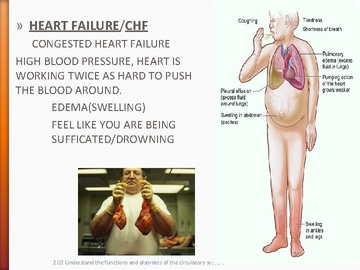 » HEART FAILURE/CHF CONGESTED HEART FAILURE HIGH BLOOD PRESSURE, HEART IS WORKING TWICE AS