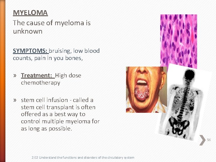 MYELOMA The cause of myeloma is unknown SYMPTOMS: bruising, low blood counts, pain in