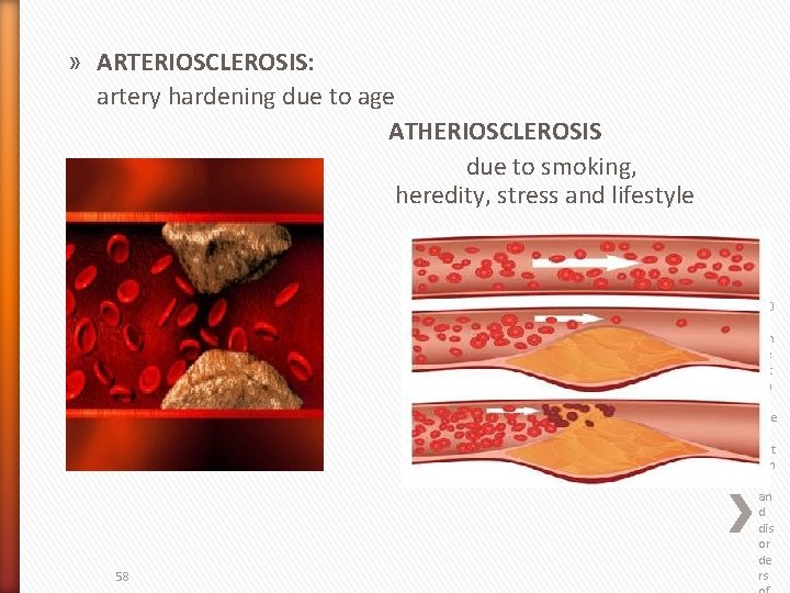 » ARTERIOSCLEROSIS: artery hardening due to age ATHERIOSCLEROSIS due to smoking, heredity, stress and