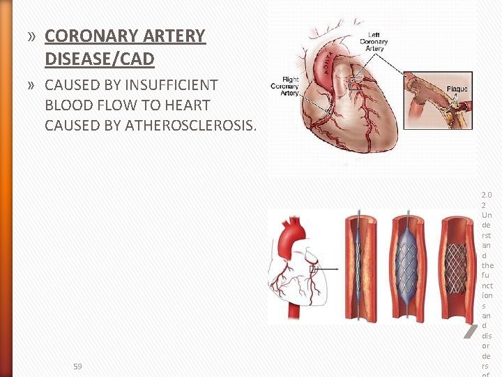 » CORONARY ARTERY DISEASE/CAD » CAUSED BY INSUFFICIENT BLOOD FLOW TO HEART CAUSED BY