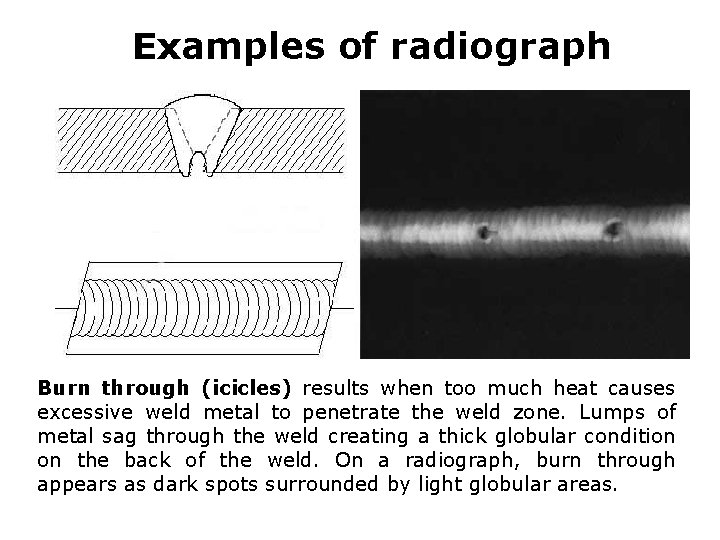 Examples of radiograph Burn through (icicles) results when too much heat causes excessive weld