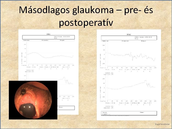 Másodlagos glaukoma – pre- és postoperatív Saját felvételek 
