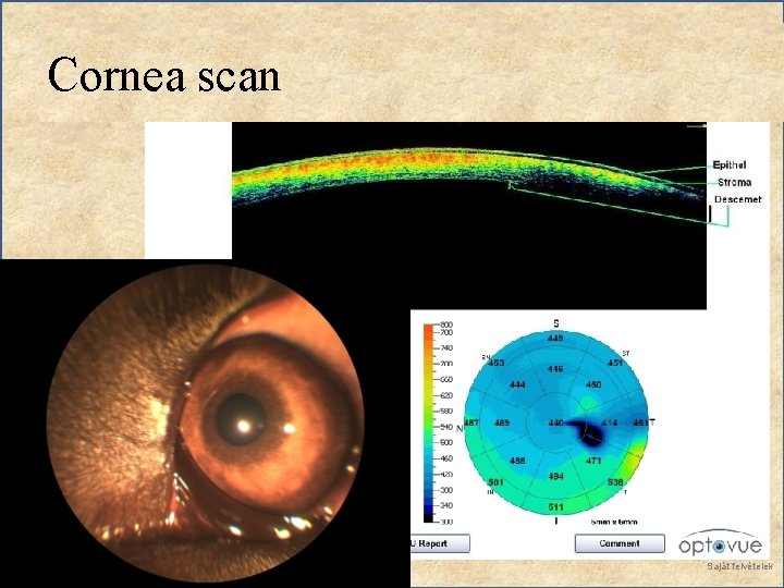 Cornea scan Saját felvételek 