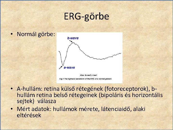 ERG-görbe • Normál görbe: Ábra: Donnell J. Creel • A-hullám: retina külső rétegének (fotoreceptorok),