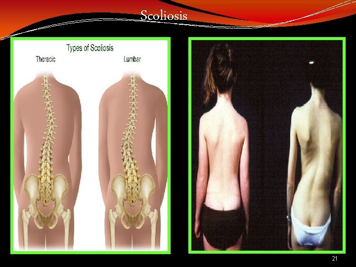 Scoliosis 21 