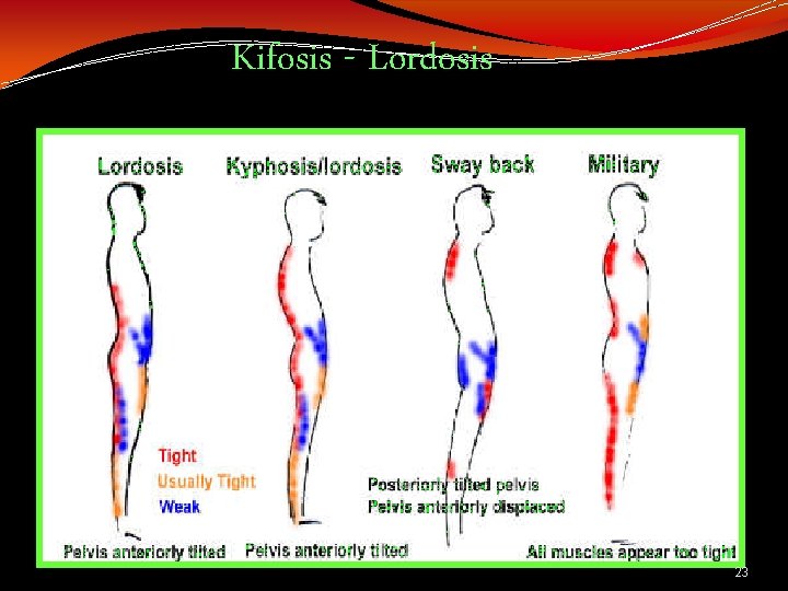 Kifosis - Lordosis 23 