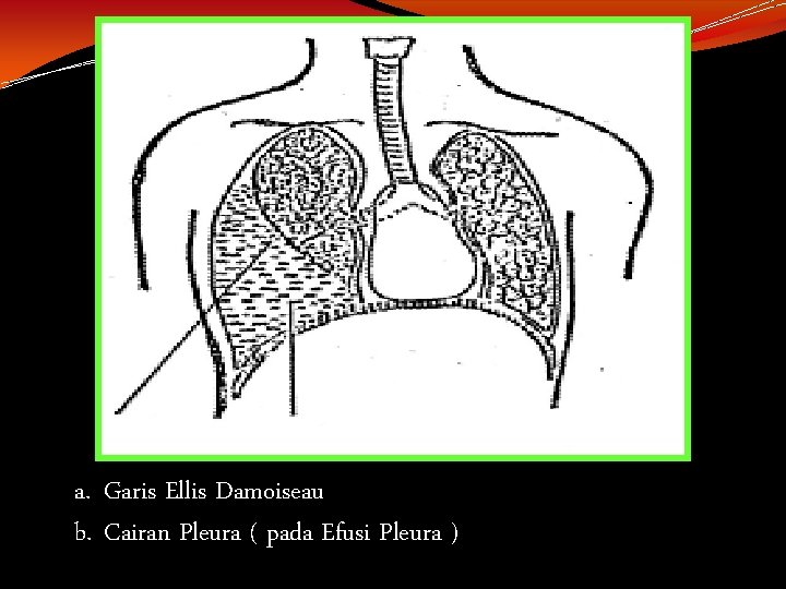 a. Garis Ellis Damoiseau b. Cairan Pleura ( pada Efusi Pleura ) 