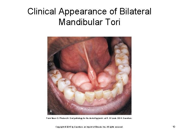 Clinical Appearance of Bilateral Mandibular Tori From Ibsen O, Phelan JA: Oral pathology for