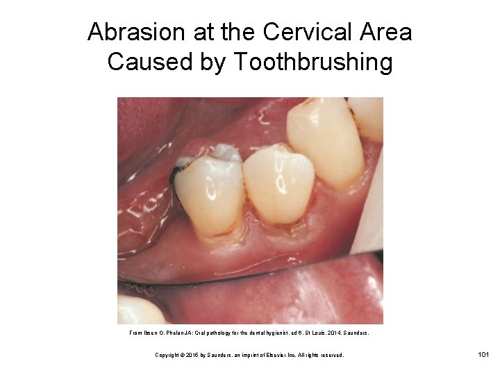 Abrasion at the Cervical Area Caused by Toothbrushing From Ibsen O, Phelan JA: Oral