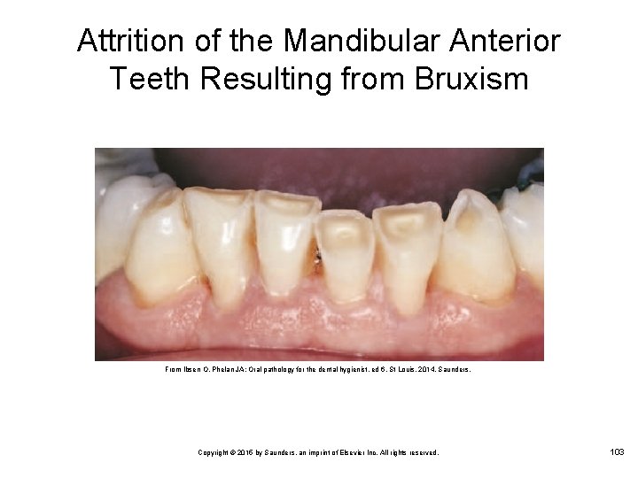 Attrition of the Mandibular Anterior Teeth Resulting from Bruxism From Ibsen O, Phelan JA: