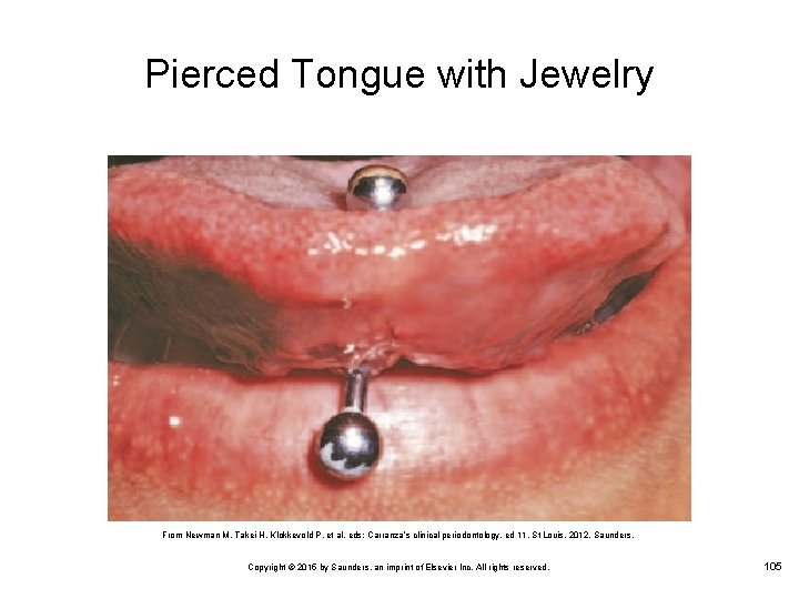 Pierced Tongue with Jewelry From Newman M, Takei H, Klokkevold P, et al, eds: