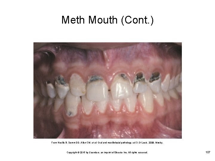 Meth Mouth (Cont. ) From Neville B, Damm DD, Allen CM, et al: Oral