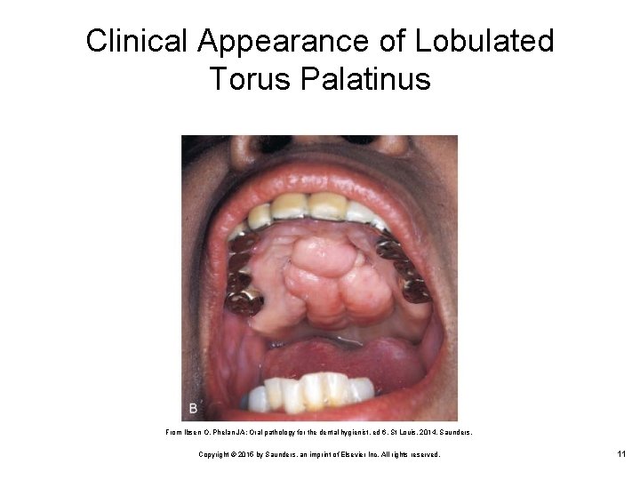 Clinical Appearance of Lobulated Torus Palatinus From Ibsen O, Phelan JA: Oral pathology for