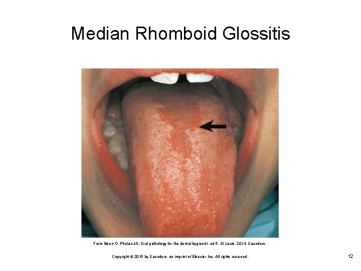 Median Rhomboid Glossitis From Ibsen O, Phelan JA: Oral pathology for the dental hygienist,