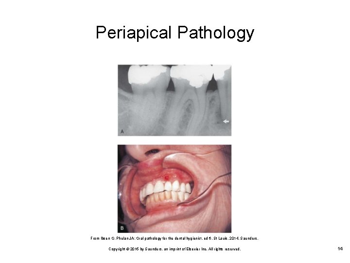 Periapical Pathology From Ibsen O, Phelan JA: Oral pathology for the dental hygienist, ed