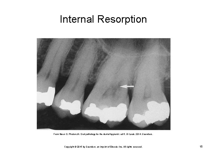 Internal Resorption From Ibsen O, Phelan JA: Oral pathology for the dental hygienist, ed