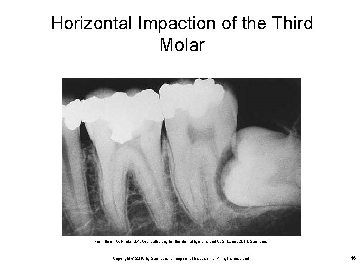 Horizontal Impaction of the Third Molar From Ibsen O, Phelan JA: Oral pathology for