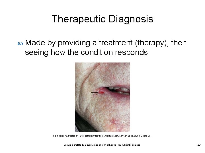 Therapeutic Diagnosis Made by providing a treatment (therapy), then seeing how the condition responds