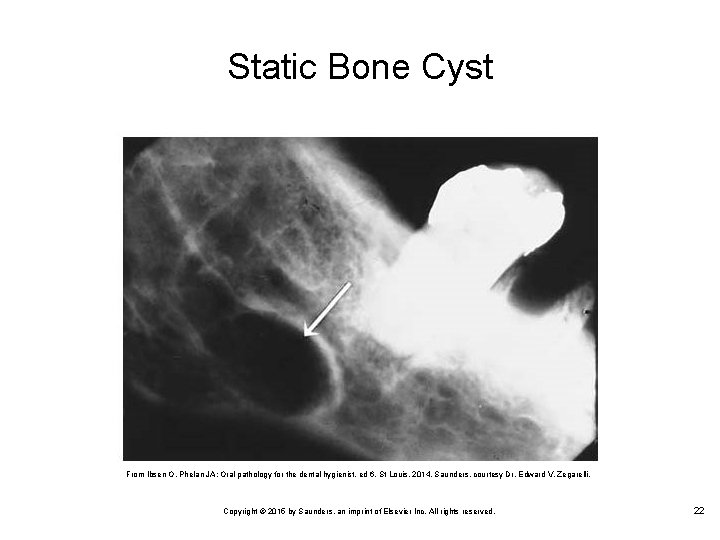 Static Bone Cyst From Ibsen O, Phelan JA: Oral pathology for the dental hygienist,